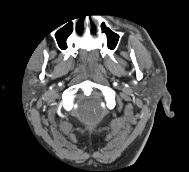 File:Basal ganglia hemorrhage (Radiopaedia 58763-65985 D 8).jpg