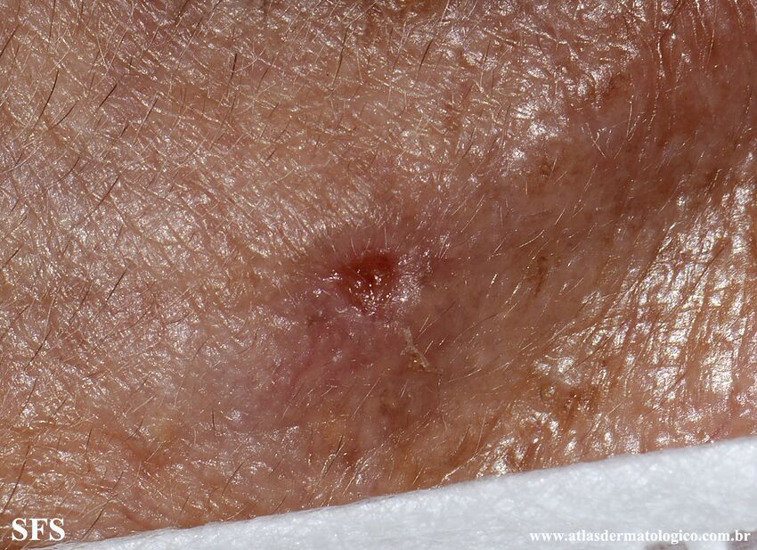 Basaloid Follicular Hamartoma-Ulcerated Basaloid Follicular Hamartoma (Dermatology Atlas 2).jpg