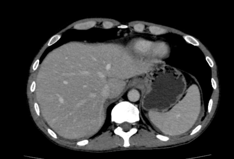 File:Behçet's disease- abdominal vasculitis (Radiopaedia 55955-62570 A 6).jpg