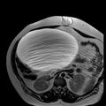 Benign seromucinous cystadenoma of the ovary (Radiopaedia 71065-81300 B 30).jpg
