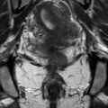 Bicornuate uterus (Radiopaedia 61974-70046 Coronal T2 22).jpg