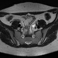 Bicornuate uterus (Radiopaedia 72135-82643 Axial T2 3).jpg