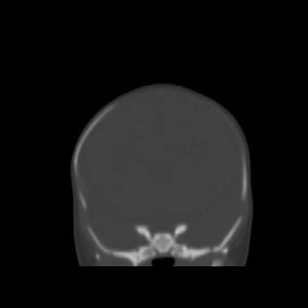 File:Bilateral cephalohematomas and subdural hematomas (Radiopaedia 26778-26929 Coronal bone window 6).jpg