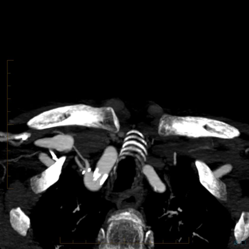 Bilateral chronic common carotid occlusion (Radiopaedia 50849-56362 D 54).jpg