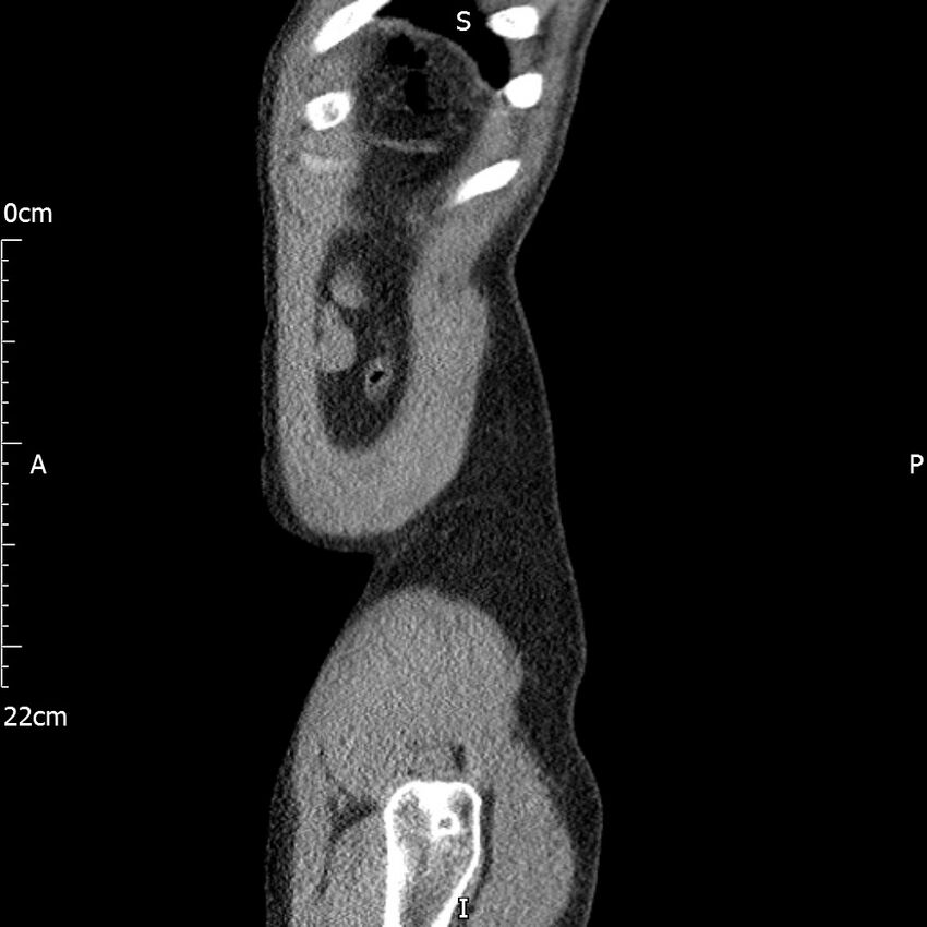 Bilateral medullary nephrocalcinosis with ureteric calculi (Radiopaedia 71269-81569 C 14).jpg