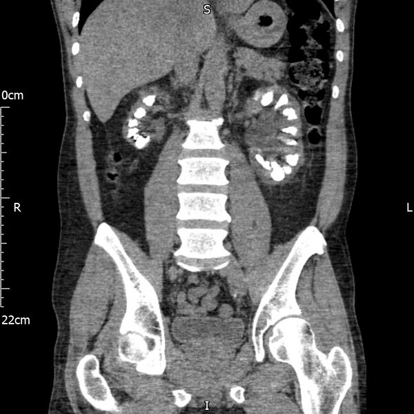 File:Bilateral medullary nephrocalcinosis with ureteric calculi (Radiopaedia 71269-81569 Coronal non-contrast 40).jpg