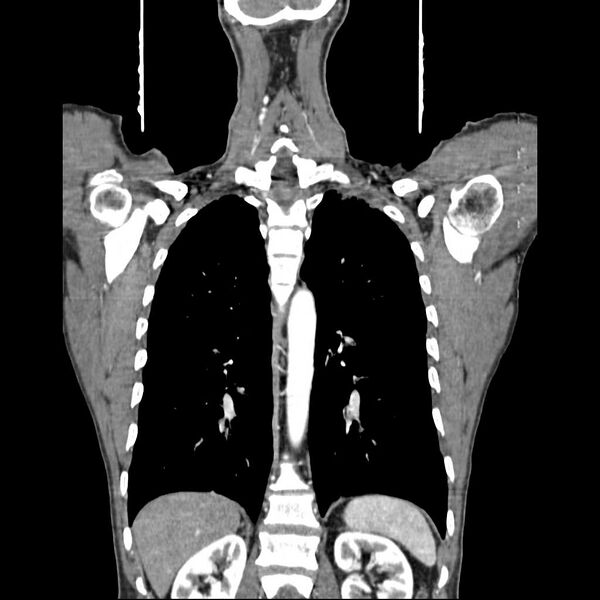 File:Bilateral parotid gland lymphoma (Radiopaedia 21038-20969 B 12).jpg