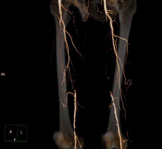 File:Bilateral superficial femoral arterial occlusion (Radiopaedia 25682-25857 3D VR 19).jpg