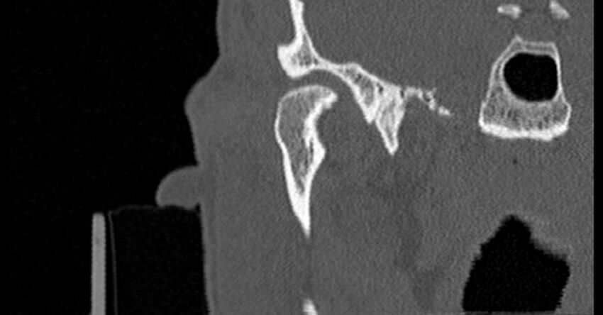 Bilateral temporal bone fractures (Radiopaedia 29482-29970 Coronal non-contrast 45).jpg