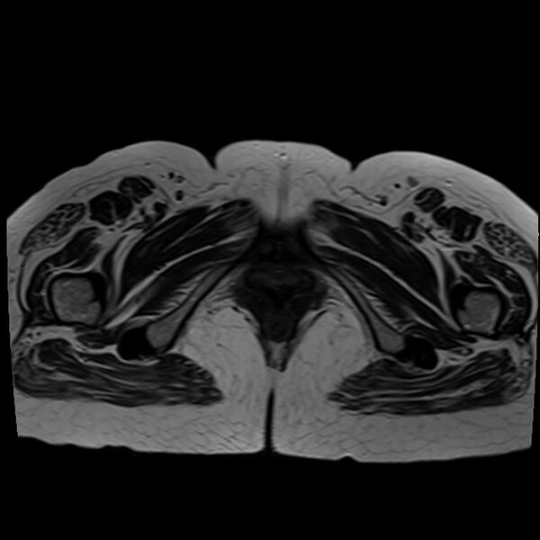 File:Bilateral tubo-ovarian abscesses (Radiopaedia 58635-65829 Axial T2 47).jpg