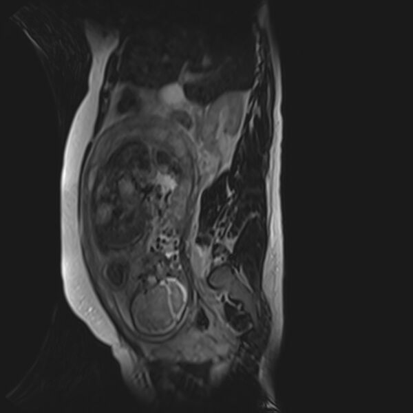 File:Bilobed placenta accreta (Radiopaedia 69648-79591 G 37).jpg