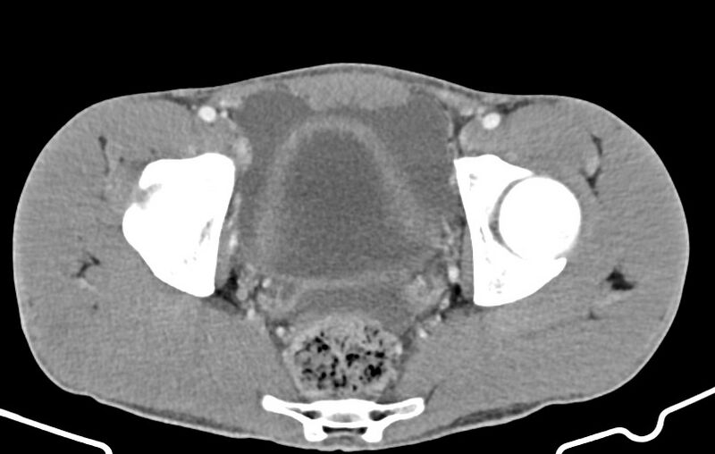 File:Blunt injury to the small bowel (Radiopaedia 74953-85987 A 175).jpg