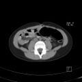 Bochdalek diaphragmatic hernia (Radiopaedia 38866-41059 A 35).jpg