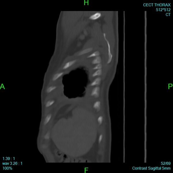 File:Bone metastases from lung carcinoma (Radiopaedia 54703-60937 Sagittal bone window 52).jpg