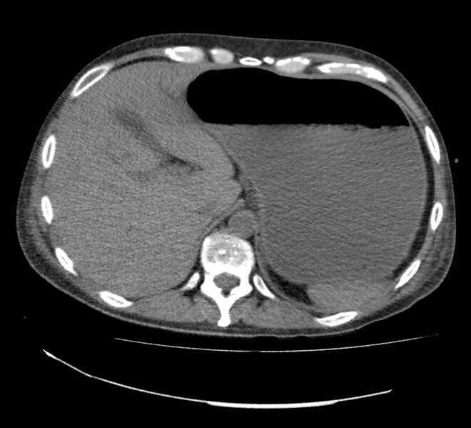 File:Bowel lymphoma complicated by bleeding after therapy (Radiopaedia 55601-62110 Axial non-contrast 16).jpg