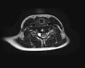 Brachial plexus birth palsy (Radiopaedia 68118-77604 Axial T2 13).jpg