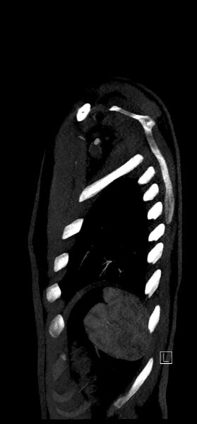 File:Brachiocephalic trunk pseudoaneurysm (Radiopaedia 70978-81191 C 83).jpg