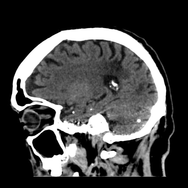 File:Brain Pantopaque remnants (Radiopaedia 78403-91048 C 19).jpg