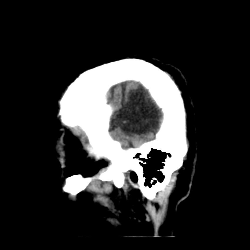 Brain Pantopaque remnants (Radiopaedia 78403-91048 C 6).jpg