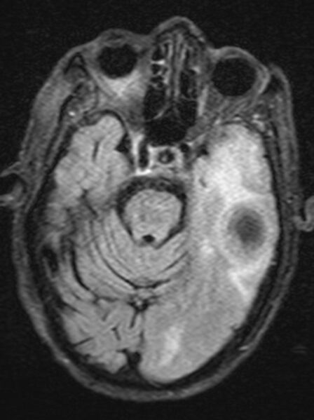 File:Brain abscess with dual rim sign (Radiopaedia 87566-103938 Axial FLAIR 7).jpg