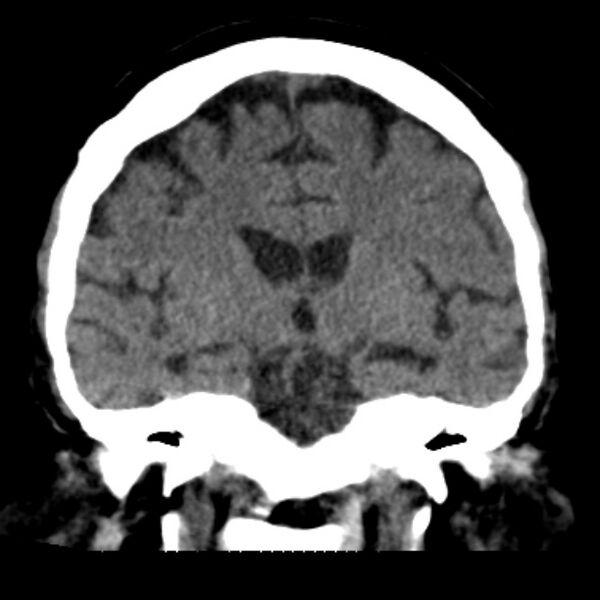 File:Brain cortical laminar necrosis (Radiopaedia 25822-25971 C 28).jpg