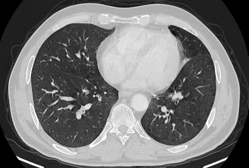 File:Brain metastases - lung cancer primary (Radiopaedia 75060-86116 Axial lung window 40).jpg