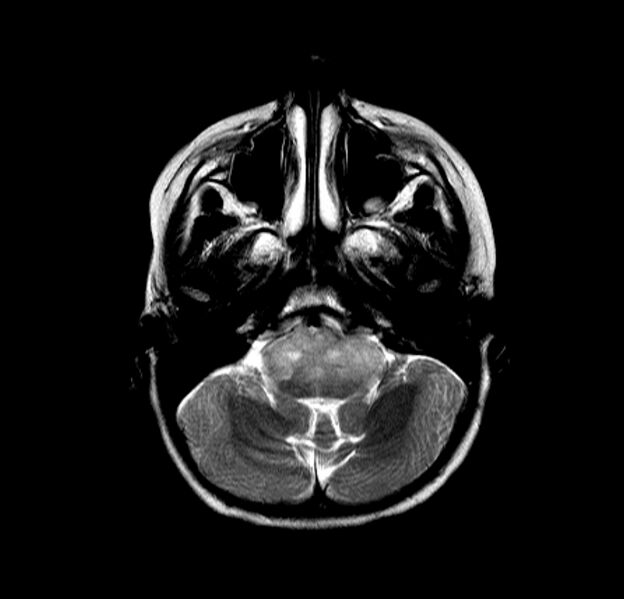 File:Brainstem glioma (Radiopaedia 5683-7390 Axial T2 1).jpg