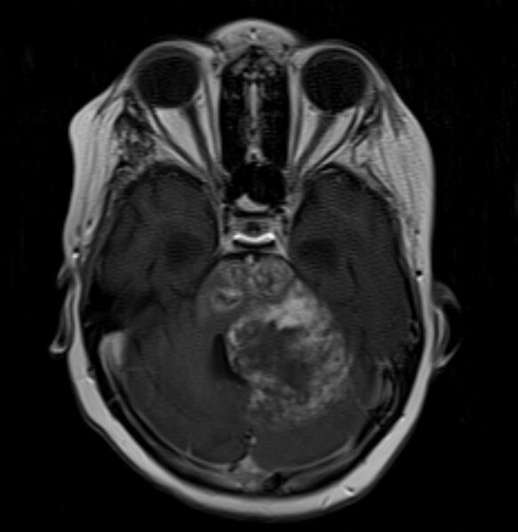 File:Brainstem glioma (Radiopaedia 6524-7839 Axial T1 C+ 1).jpg