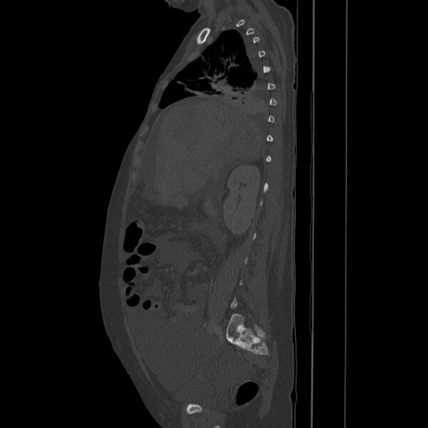 File:Breast cancer metastases - hepatic and skeletal (Radiopaedia 34201-35461 Sagittal bone window 37).jpg