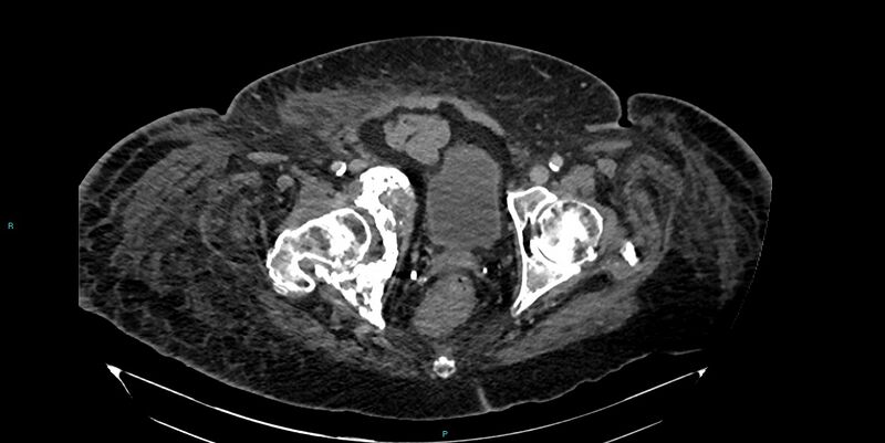 File:Breast cancer pelvic bony metastases (Radiopaedia 84470-99824 Axial bone window 58).jpg