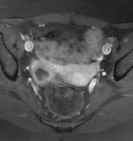 File:Broad ligament leiomyoma (Radiopaedia 81634-95516 Axial T1 C+ fat sat 12).jpg