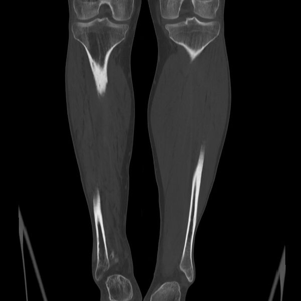 File:Brodie abscess - tibia (Radiopaedia 66028-75204 Coronal bone window 48).jpg