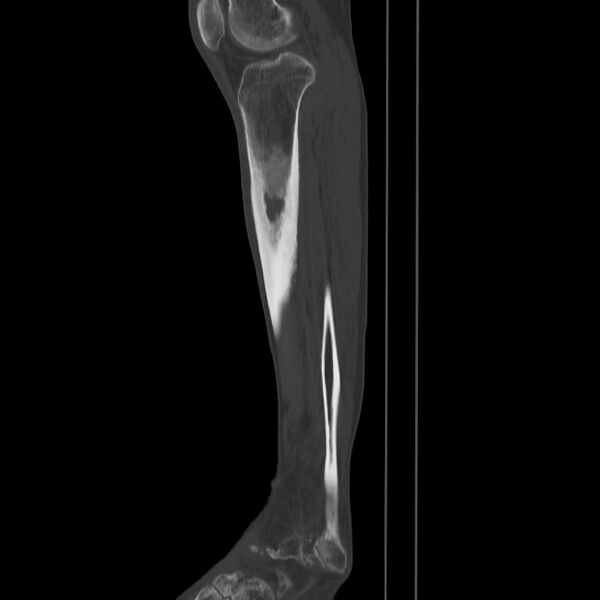 File:Brodie abscess - tibia (Radiopaedia 66028-75204 Sagittal bone window 48).jpg