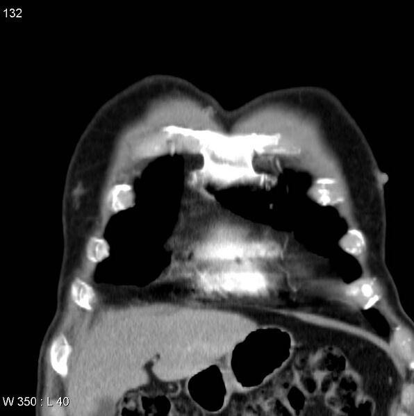 File:Bronchial carcinoid tumor with right lower lobe collapse (Radiopaedia 29060-29422 C 1).jpg