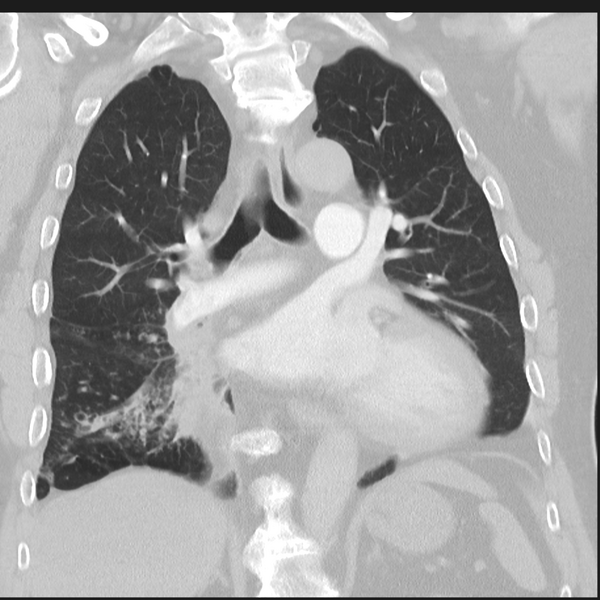 File:Bronchiectasis (Radiopaedia 39385-41666 Coronal lung window 17).png