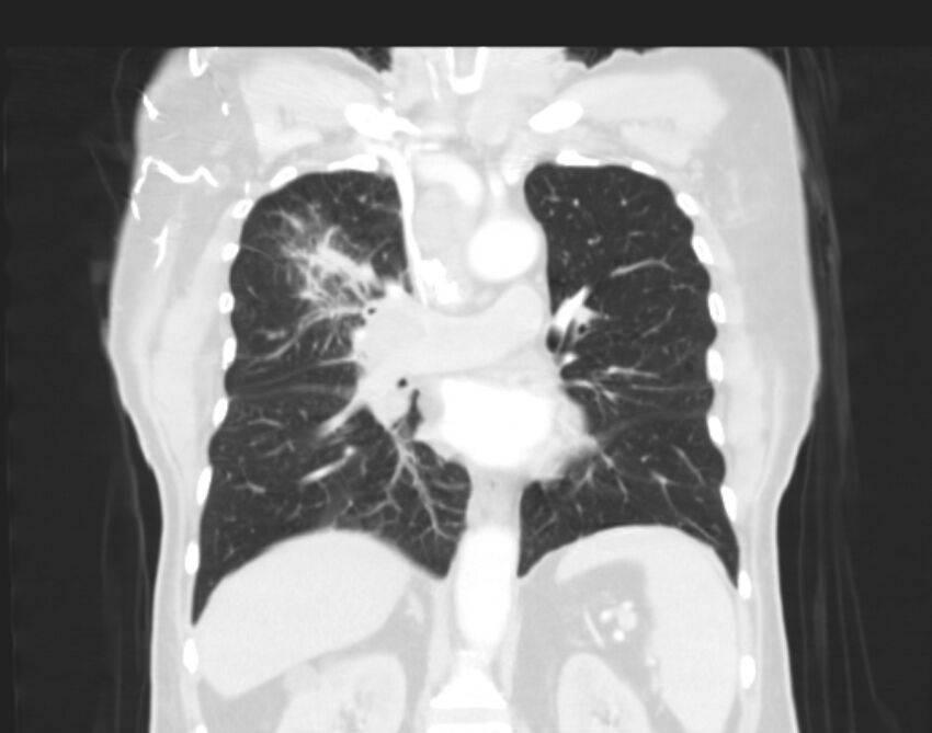 Bronchogenic carcinoma with lymphangitic spread (Radiopaedia 29002-29357 Coronal lung window 35).jpg