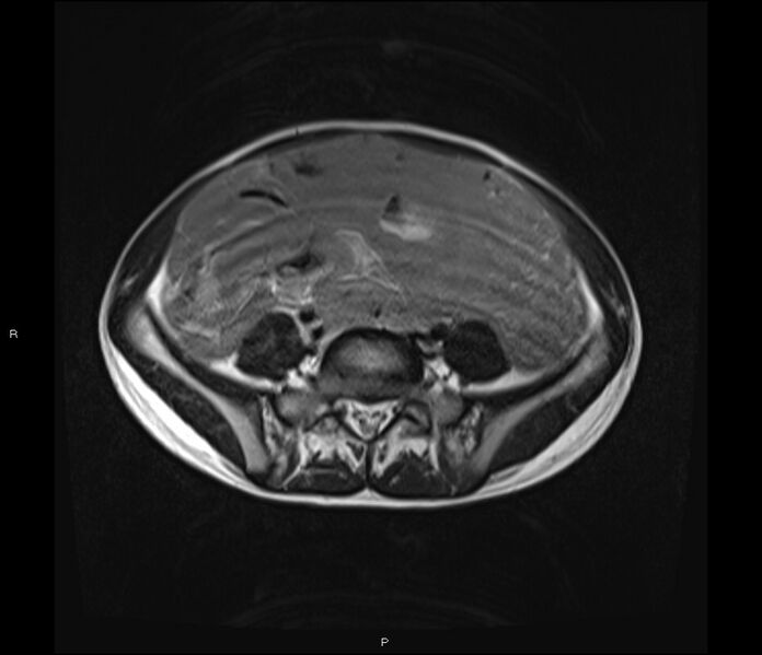 File:Burkitt lymphoma (bowel) (Radiopaedia 68839-78557 Axial T2 44).jpg