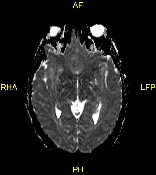 File:Butterfly glioma (Radiopaedia 76707-88526 Axial ADC 12).jpg