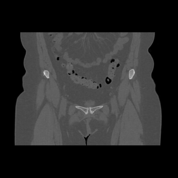 File:Calcific tendinitis of the gluteus medius muscle (Radiopaedia 66998-76318 Coronal bone window 12).jpg