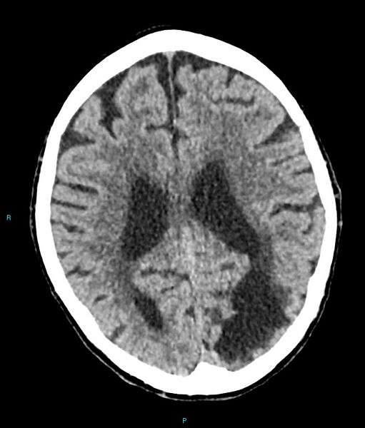 File:Calcified cerebral emboli from left ventricular thrombus (Radiopaedia 84420-99758 Axial non-contrast 37).jpg
