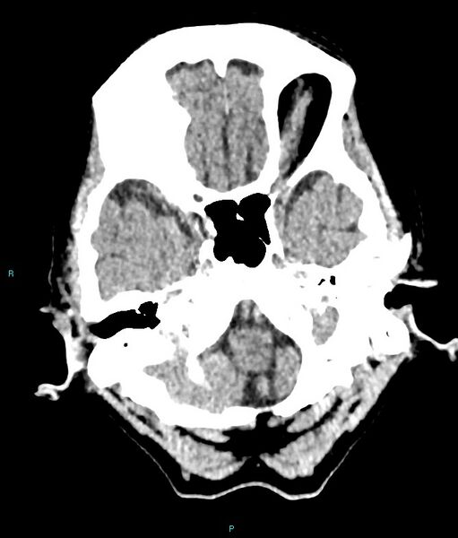 File:Calcified cerebral emboli from left ventricular thrombus (Radiopaedia 84420-99758 Axial non-contrast 76).jpg