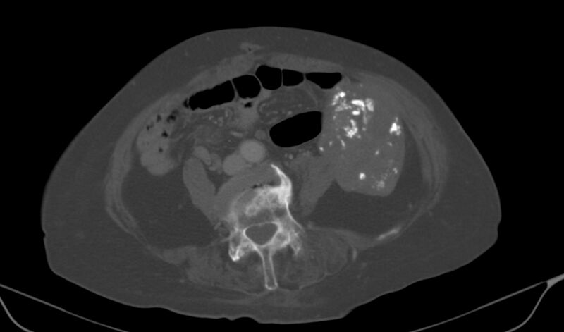 File:Calcified fibroids (Radiopaedia 20306-20228 Axial bone window 5).jpg