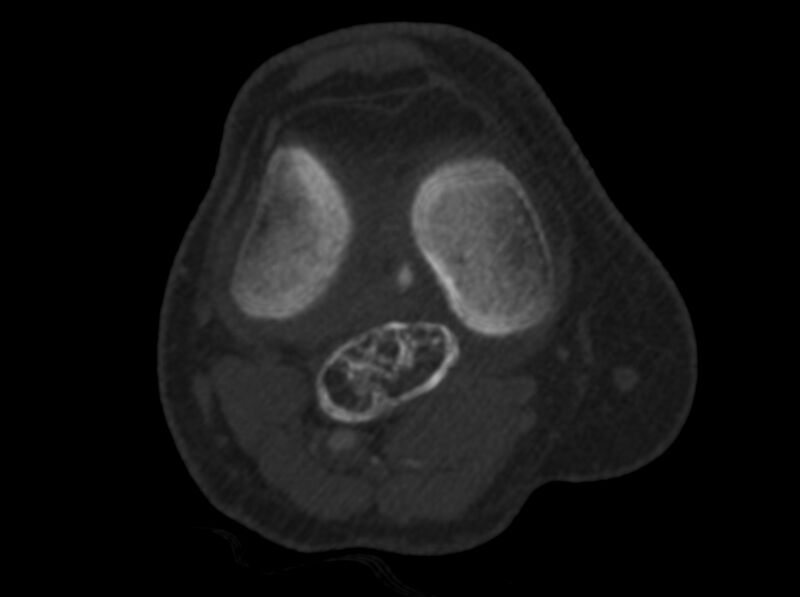 File:Calcified hematoma - popliteal fossa (Radiopaedia 63938-72763 C 17).jpg