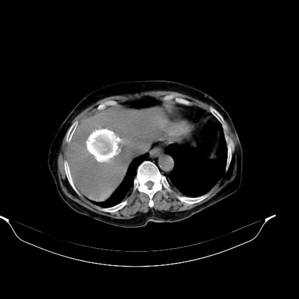 File:Calcified hydatid cyst (Radiopaedia 62000-70085 Axial non-contrast 22).jpg