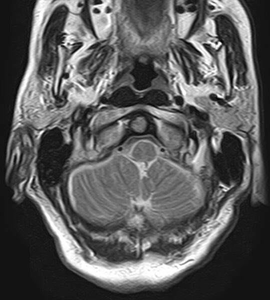 File:Calcified meningioma - cervical canal (Radiopaedia 70136-82468 Axial T2 2).jpg