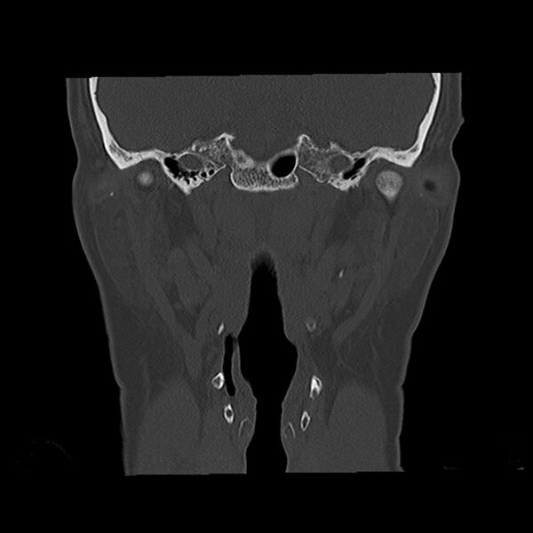 File:Canal up mastoidectomy (Radiopaedia 78108-90638 Coronal bone window 30).jpg