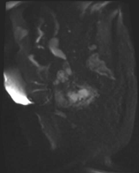 File:Cancer cervix - stage IIb (Radiopaedia 75411-86615 Sagittal DWI 54).jpg