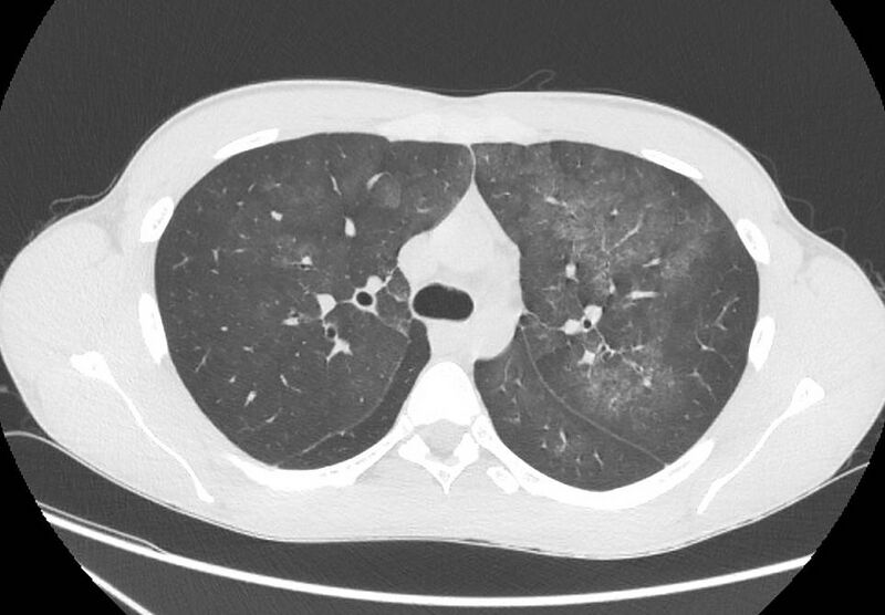 File:Cannabis-induced diffuse alveolar hemorrhage (Radiopaedia 89834-106946 Axial lung window 39).jpg