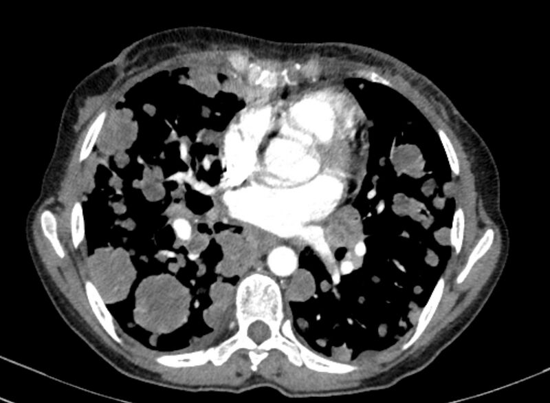 File:Cannonball metastases from breast cancer (Radiopaedia 91024-108569 A 69).jpg