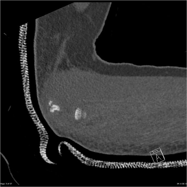 File:Capitellum fracture (Radiopaedia 23352-23426 Sagittal bone window 5).jpg